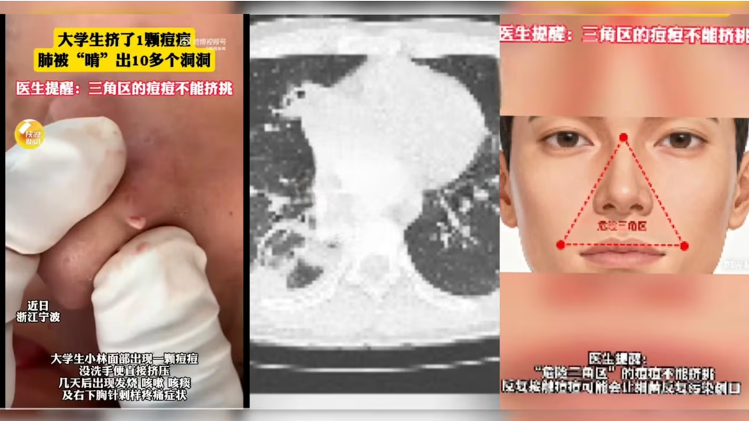 中國男生擠痘痘感染細菌 肺被「啃」出十多個空洞